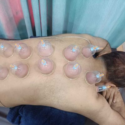 best cupping therapy near me