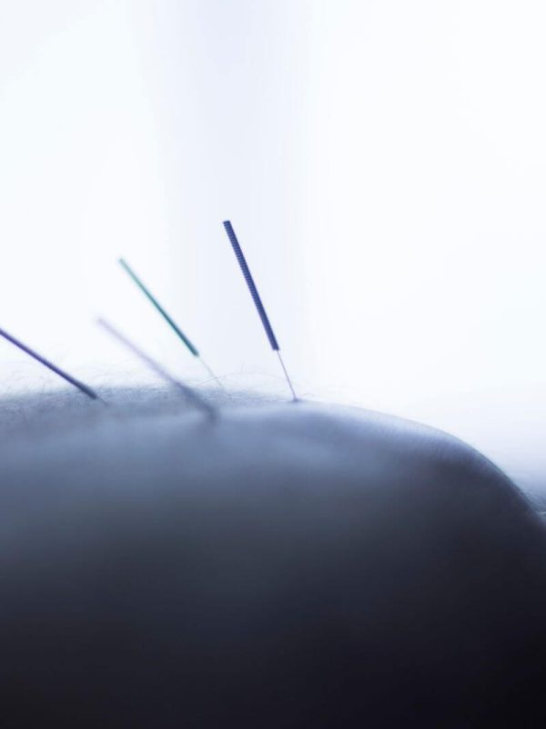 dry needling physical therapy